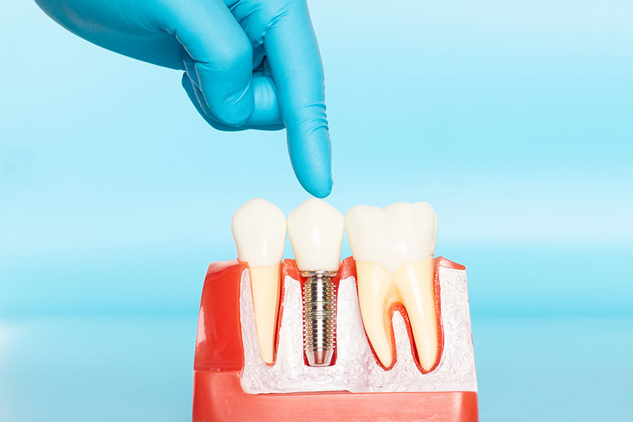 How to Find Dental Insurance That Covers Implants